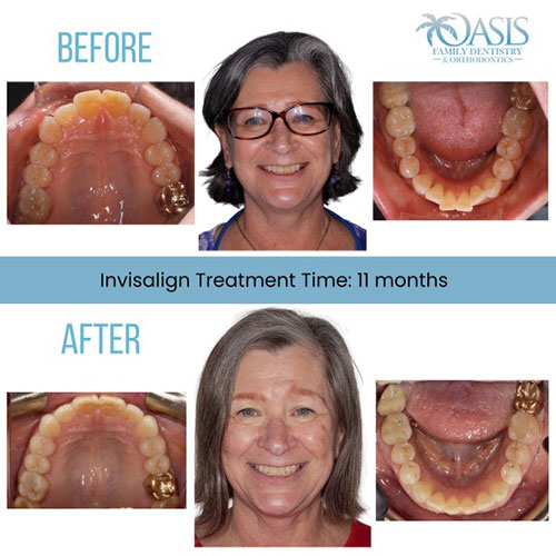 Invisalign® Tempe, AZ, Shalimar Family Dentistry