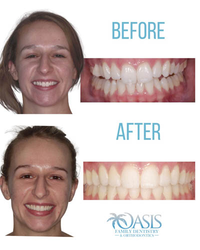 female patient has great success with Invisalign orthodontics from Oasis Family Dentistry
