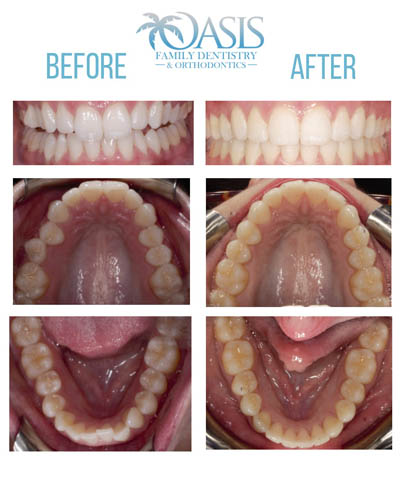 before and after photo of Invisalign orthodontics