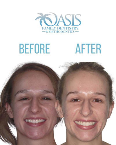 before and after Invisalign case