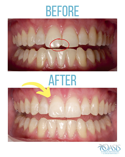 a before and after photo of dental veneers done by Oasis Family Dentistry and Orthodontics